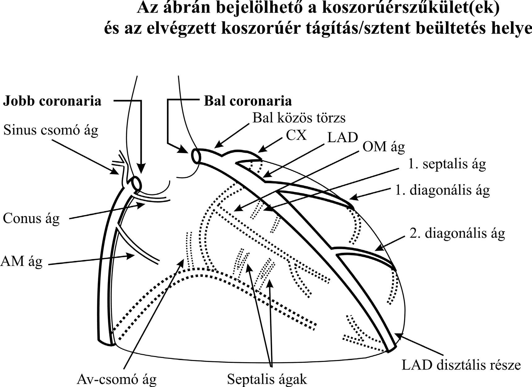 4.BETEGTÁJÉKOZTATÓ. Szívkatéterezés, koszorúértágítás és sztentelés - PDF  Free Download