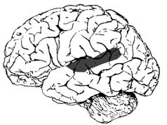 Broca-afázia Wernicke-afázia A Broca-terület sérülése önmagában sokszor nem okoz Broca-afáziát Általában a Broca-terület és a környező régiók is sérültek A Wernicke-terület sérülése önmagában gyakran