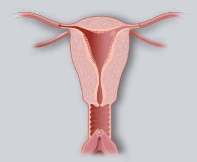 A hüvelyrákok 85-90%-a a vaginát borító hámrétegbôl indul ki, és gyakran tünetmentes. Szeméremtestrák: figyelni kell a korai jeleket.