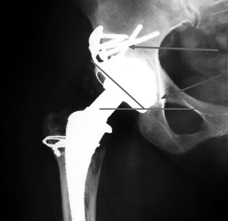 Váparekonstrukciós lehetőség kiterjedt os ilii defektus esetén revíziós műtétekben A műtét után a betegeket a második posztoperatív napon állítottuk lábra, a műtétet követő hat hétig részleges