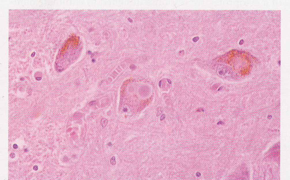 parkinsonismus,