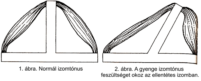 mihelyt folytatta korábbi életét, újra jelentkeztek az izomgörcsei is, és ezzel együtt visszatért a merevség és a fájdalom.