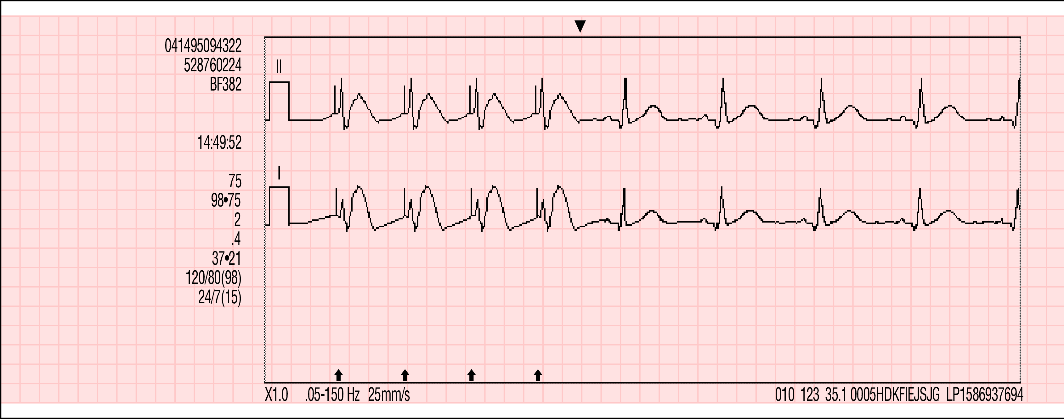 ábra Példák hullámforma-események nyomtatásban történő megjelenítésére Memóriakapacitás A LIFEPAK 15 monitor/defibrillátor két vagy több beteg adatait megőrzi a tápfeszültség kikapcsolása vagy az