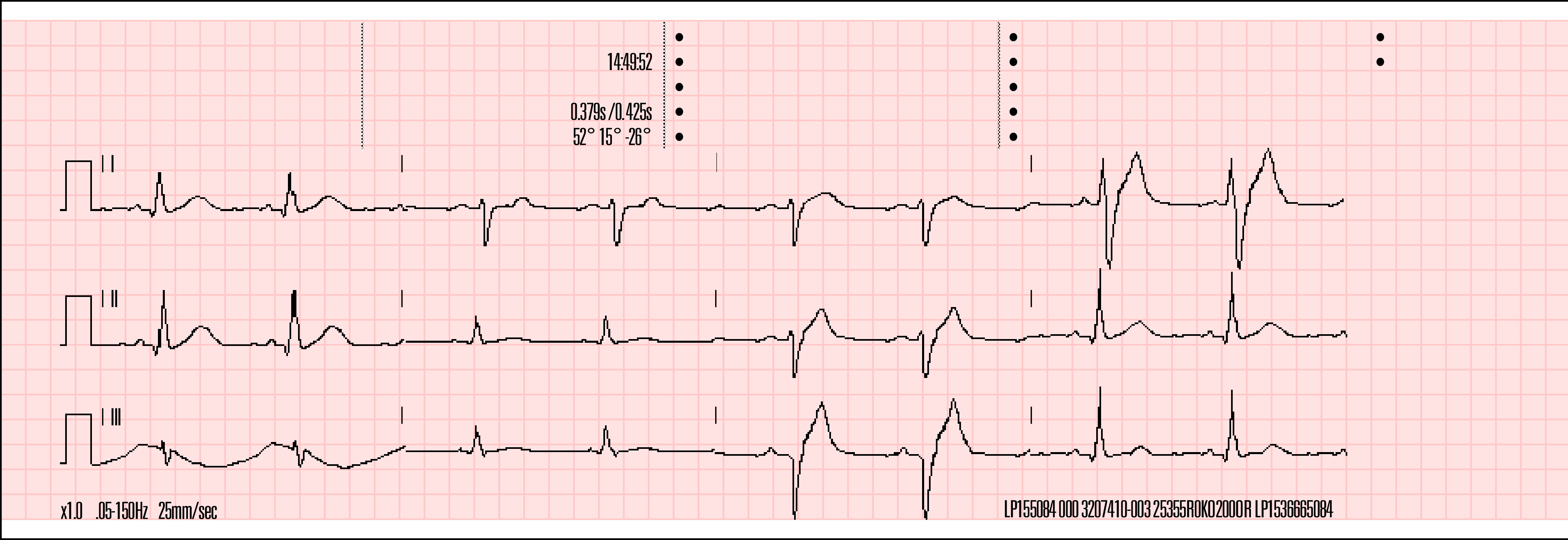 A kinyomtatott 12 elvezetéses EKG jelentés formátumai Két 12 elvezetéses EKG-jelentésformátum érhető el nyomtatási célra: 3 csatornás és 4 csatornás.