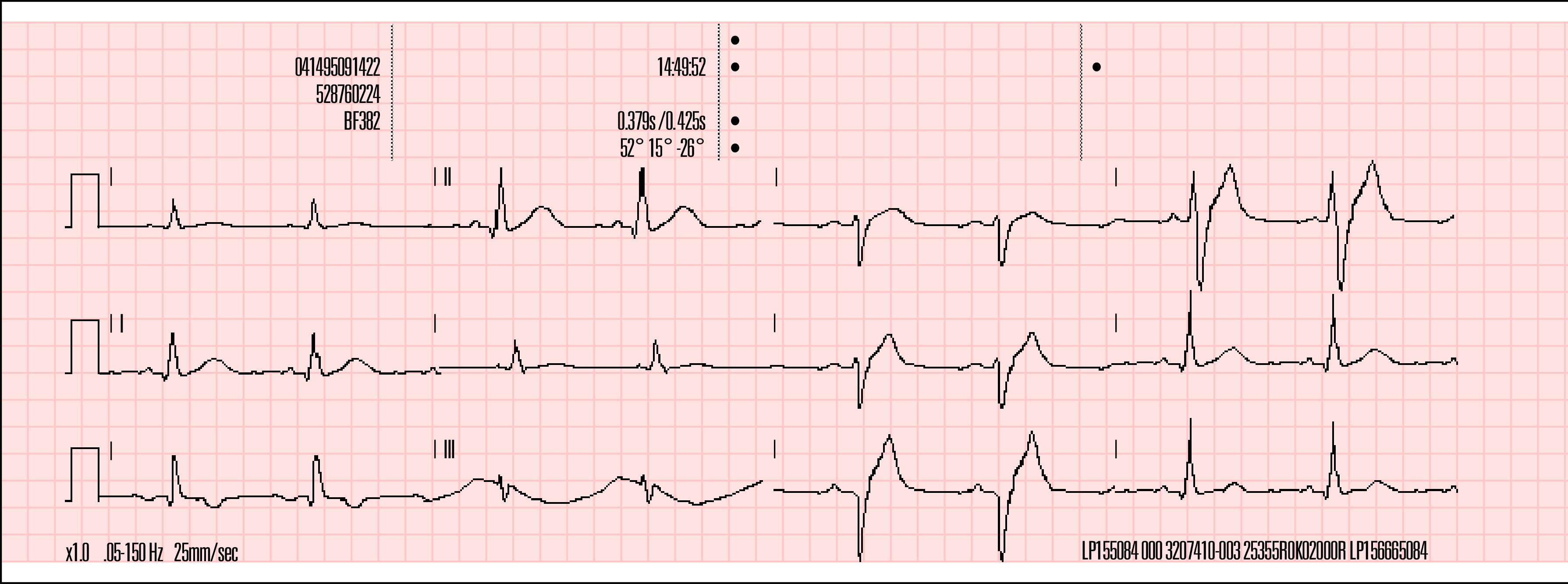 MONITOROZÁS 4 Name: Record ID: Patient ID: Incident: Age: 50 avl Lee, William Sex:M 12-Lead 1 24 Apr 08 PR 0.170s QT/QTc P-QRS-T Axes HR 78 bpm QRS 0.