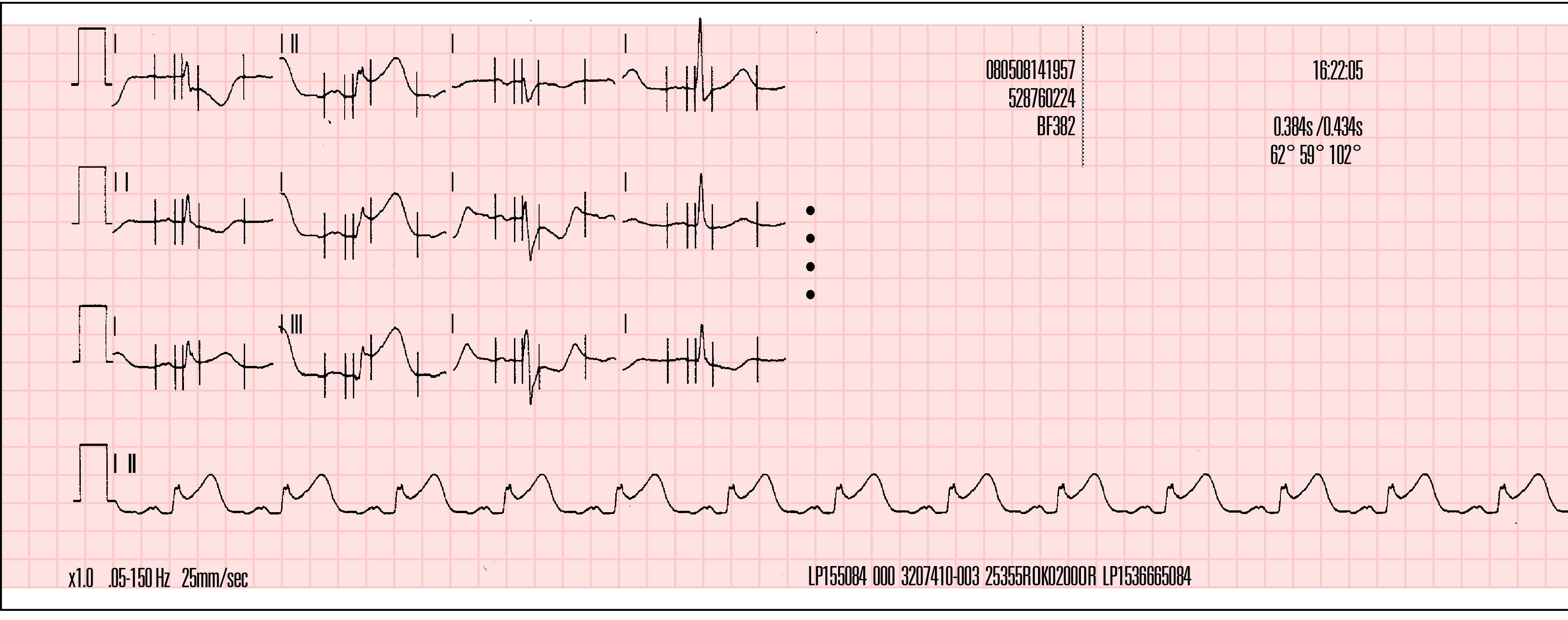 avl -avr avf V1 V2 V3 V4 V5 V6 Name: Record ID: Patient ID: Incident: Age: 50 Lee, William Sex: M 12-Lead 1 24 Apr 08 PR.168s QT/QTc P-QRS-T Axes HR 89 bpm QRS 0.