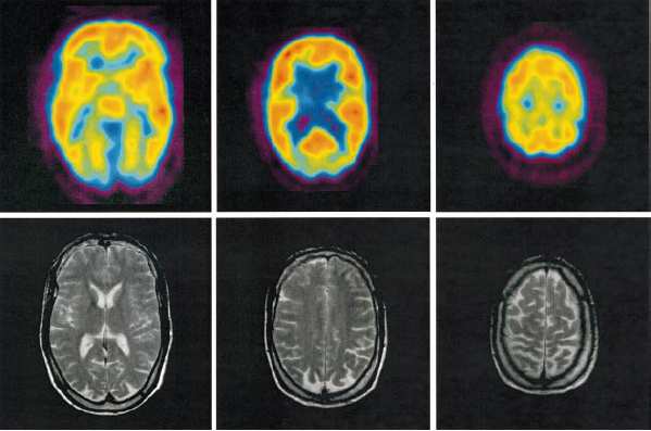 Mohr-Tranebjaerg szindroma X-hez kötött halláscsökkenés, demencia, dystonia, látászavar, neuropathia, gyerekkori, de felnıttkori is Basalis