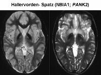 Pantothenate kináz asszociált neurodegeneráci ció (PKAN) Pantothenate kináz asszociált neurodegeneráci ció (PKAN)