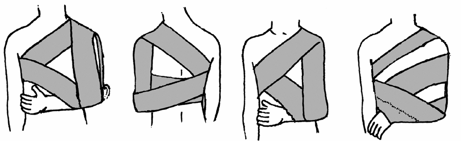 A6. MODUL Sebellátás 6. Rész Rögzítő/retenciós kötések Sérült testrészek rögzítésére használható (pl. a sérült végtag repozíció utáni nyugalmi helyzetben történő rögzítése).
