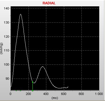 P 1 Systole Diastole Nem észlelhető a késői (reflektált P 2 ) systolés hullám.
