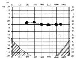 Szabadhangtérben, hallókészülékkel mért audiogram Hallássérülés mértéke: A mért átlagos