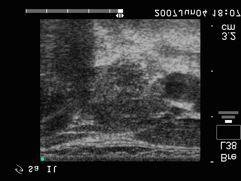 50. eset 1. kép: papilláris microca. Hashimoto-thyreoiditis mellett. Bal lebeny harántmetszet.