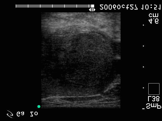 42. eset 1. kép: adenoma microfoll. (hist.) Bal lebeny harántmetszet. A lebeny nagy részét elfoglaló göb medialis, trachea közeli részén szabálytalan, a göb határait is elmosó terület. 42. eset 2.