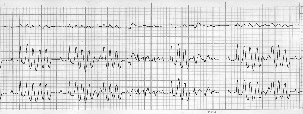 EKG ESETEK Az EKG görbén változóalakú, amplitúdójú, polaritású kamrai extrasystolék.