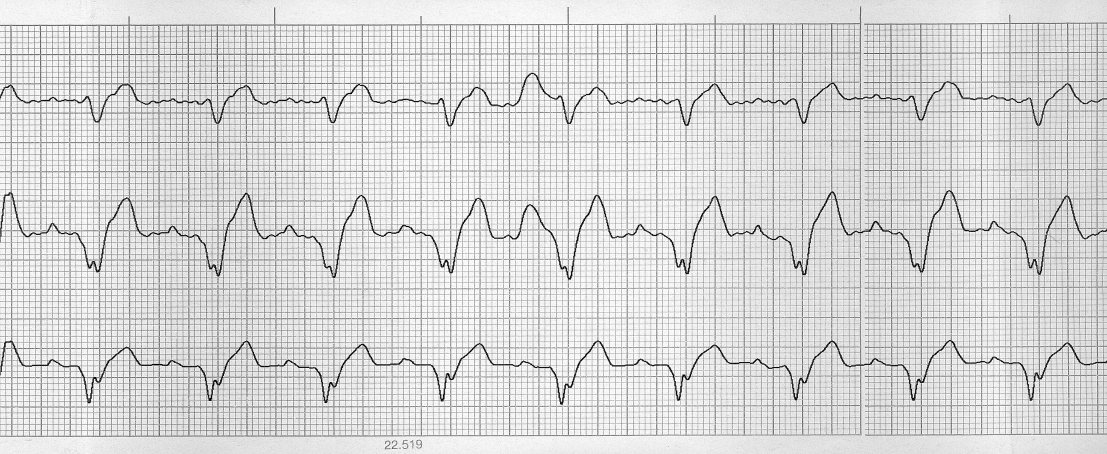 160/p, az összes QRS megszélesbedett, polaritásuk megváltozott, a QRS kétcsúcsú, azonban minden QRS-t szabályos időben megelőz egy hozzátartozóp-hullám, vagyis a pitvarkamrai átvezetés normális, és