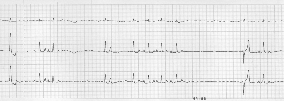 os Klinikai tünetek: Súlyos elesettség, subnormális testhőmérséklet, dyspnoe. Bradycardia, arrhythmia, mitralisbillentyűfölött IV/VI systolés zörej. 130/p, az alapritmus normal sinus ritmus.