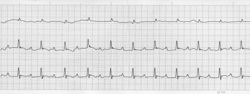 150/p, sinus tachycardia. PQ-intervallum0,16 s., I-fokú AV-blokk. A PQ-megnyúlás digitalis túladagolás elsőekg jele. 220/p, sinus tachycardia. Az I. elvezetésben a QRS negatív, II. és III.