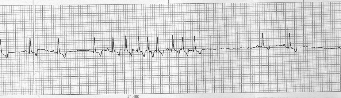 A beteg a pacemaker műtéti beültetése kezdetén elhullott. Alapritmus 80/p, sinus bradycardia. Az elsőnégy ütés normál sinus ütés. 5-11.