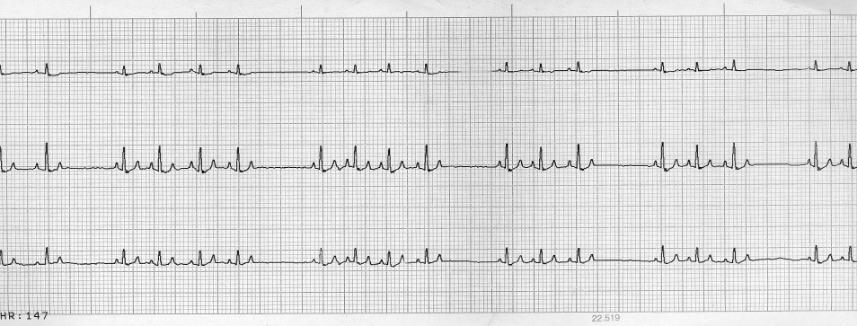 135/p szívfrekvencia, a normál sinus ütés képét mutatóütések frekvenciája szabályos időközönként felgyorsul majd lelassul. Szabályosan szabálytalan ritmus. Kifejezett sinus arrhythmia.