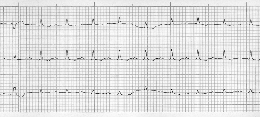 A májban kifejezett pangás jelei voltak megfigyelhetők, de ascitesmég nem volt. Ez az EKG-elváltozás a DCM korai stádiumára jellemző.