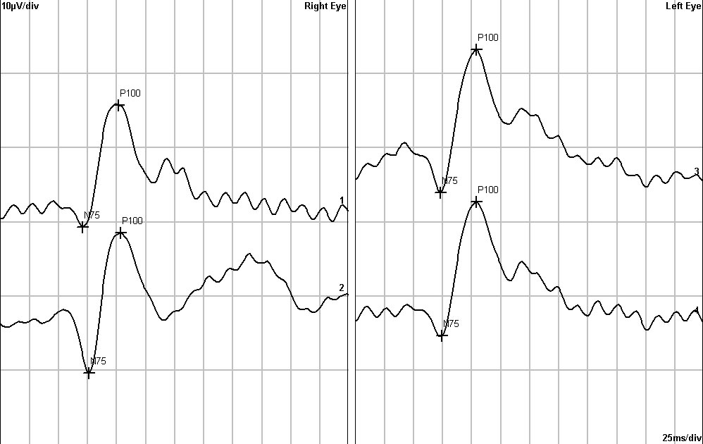 Visus: 0,15-0,5 Dsph/stp=0,5 o.u. (tükörből