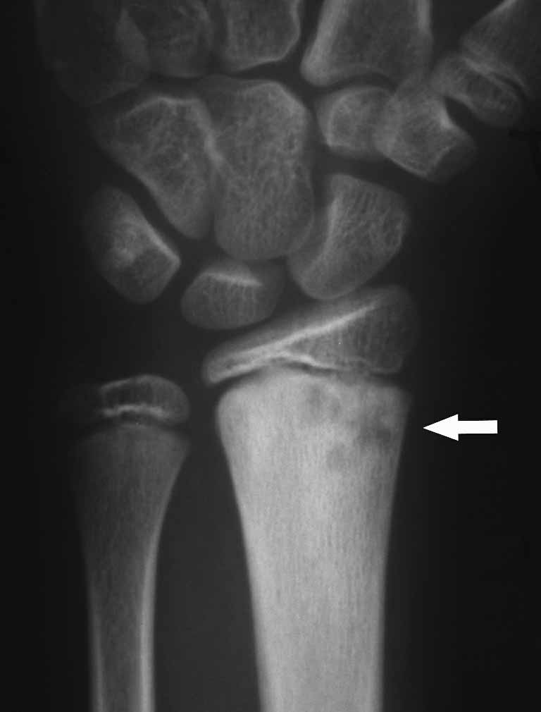 6 hónap múlva a jobb csukló folyamatos javulása mellett a bal csukló vált fájdalmassá. Rtg felvételen a bal radius distalis metaphysisén látszott igen apró felritkulás, minimális sclerosissal.