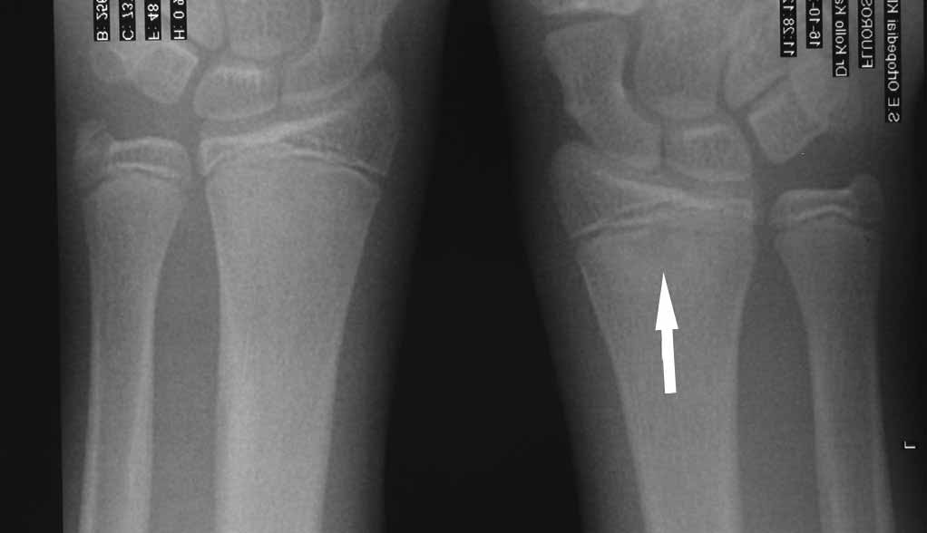 A lábközi interphalangealis artrosis, Ízületi porckopás (artrózis) - Tünetek és okok