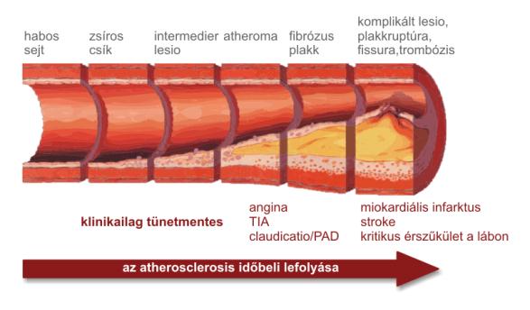 Az érelmeszesedés (kásadaganat) (hegszerű)