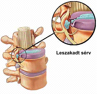 fáradékonyság, terhelhet ség csökken, gerinc egyre jobban merevedik terápia: úszás, torna rendszeresen 3, Discopathia; discushernia gerinc porckorongjainak elváltozásai, gerincsérv oka: porckorong