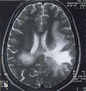 Megelőzés - Rendszeres ellenőrzés: Klinikai tünetek (cognitiv funkciók) Laboratórium (JC-vírus) MRI PML Kezelés Plasmacsere 3