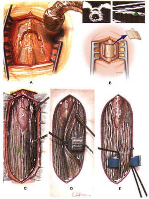 Surgical Procedure 4-5 h OP Midline lumbar incision Laminae are reflected but not resected Dura is opened to expose nerve rootlets from L1-S2 laminectomy from 5-7 (Parks