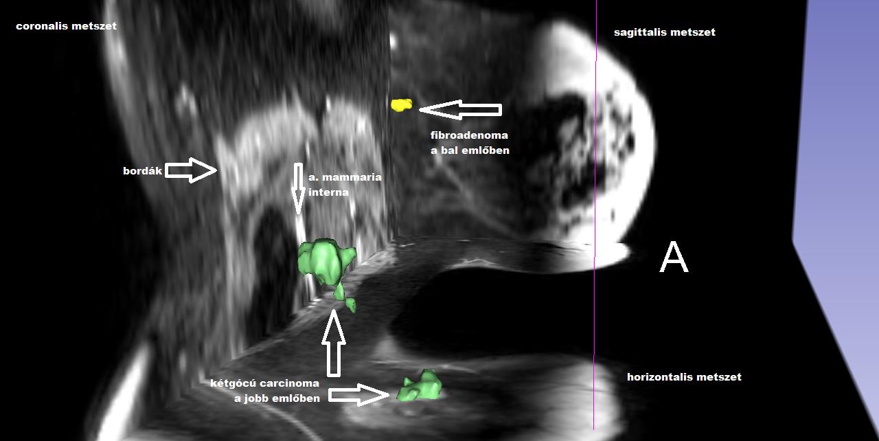 30 8. ábra: ugyanazon elváltozások lateralis irányból nézve, más színekkel megjelenítve 9. ábra: a fenti képeken megjelenített malignus karakterű tumor és térfogata.