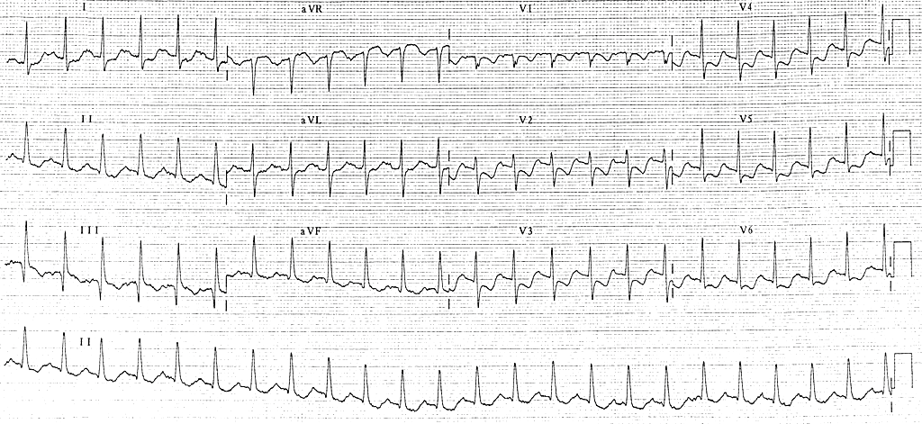 Angina