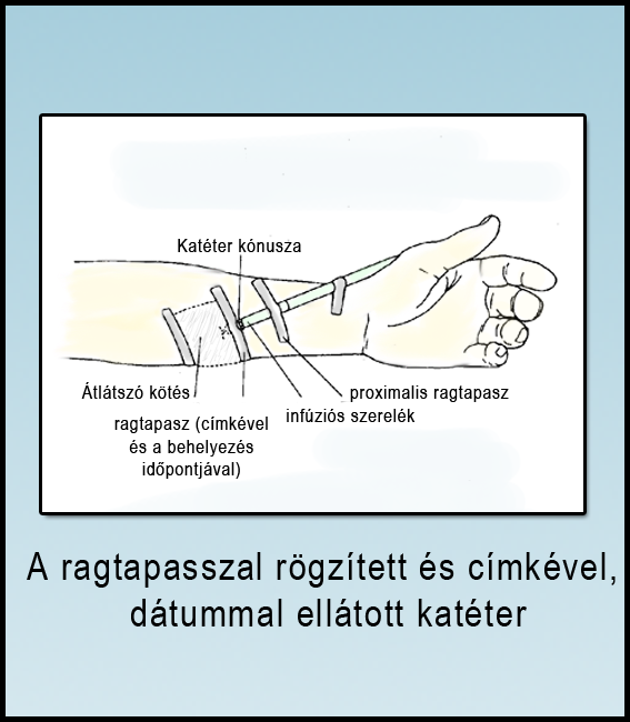 7. ábra A ragtapasszal rögzített és címkével, dátummal ellátott katéter II.