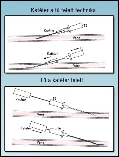 2. ábra Katéter a tű felett és katéter a tűn keresztül (vagy tű a katéter felett) technikák A vénabiztosítás szempontjából különleges helyzetnek minősül az ún. sürgősségi vascularis út biztosítása.