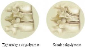 Csípőtáji törések 16 000 évente Csuklótáji törések