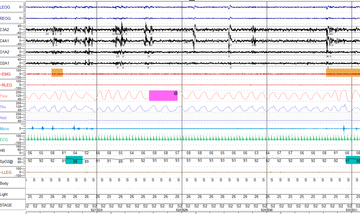 F.R. Intense K wave