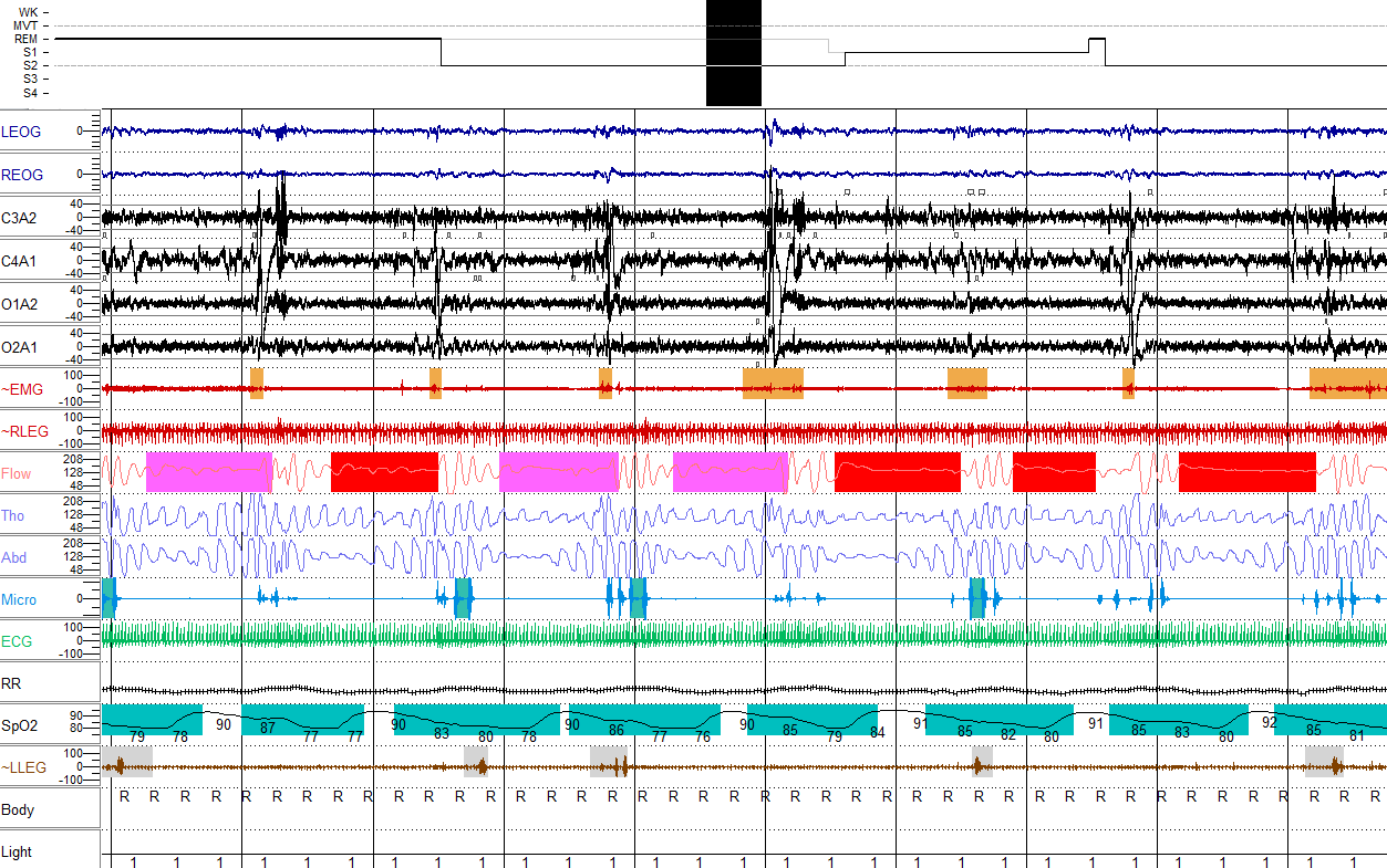 K complex arousal