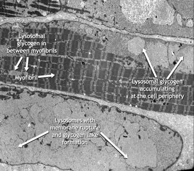 POMPE A myofibrillumok helyét glycogen foglalja el, egyidejű