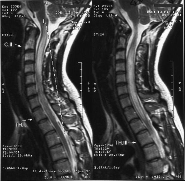 » KRITÉRIUM: különböző alaptünetek jellegzetesek:» optic neuritis; acute myelitis;» area postrema syndroma (émelygés, hányás és csuklás);» egyéb agytörzsi tünetek; symptomás narcolepsia vagy acute