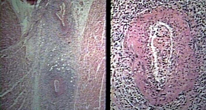 herefájdalom/érzékenység diffúz myalgia mono-polyneuropathia hypertonia (diastole>90 Hgmm) BUN vagy kreatininszint emelkedés HBV antigén vagy antitest pozitivitás