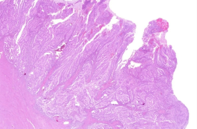 Kulka J és munkatársa MÉHTESTDAGANATOK WHO SZÖVETTANI BEOSZTÁSA (1) HÁMEREDETÛ DAGANATOK ÉS A HÁMSZÖVET EGYÉB ELVÁLTOZÁSAI Endometrialis rák Endometrioid mirigyrák Laphám irányú differenciációt