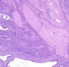 jelentôsen eltérnek a környezô ép területtôl. MÉHNYÁLKAHÁRTYA-POLIP (ENDOMETRIALIS POLYPUS) Ezek a növedékek jóindulatú monoclonalis sejtgyarapodás eredményei.