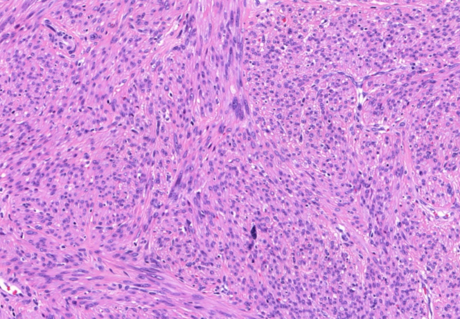 Kulka J és munkatársa állomány választja el egymástól. Meglepô módon nem annyira sejtdús, és a sejtosztódások száma is kisebb, mint a szokványos leiomyosarcoma esetében.
