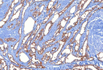 e) Myxoid leiomyoma A daganatsejteket nyálkaszerû alapállomány választja el egymástól, általában puhábbak, mint a szokványos simaizom-daganatok, és áttetszôek is lehetnek.