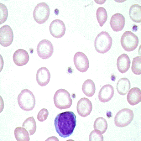 Cell Dyn3700 2. sz. ábra: Vashiányos anaemia 3.