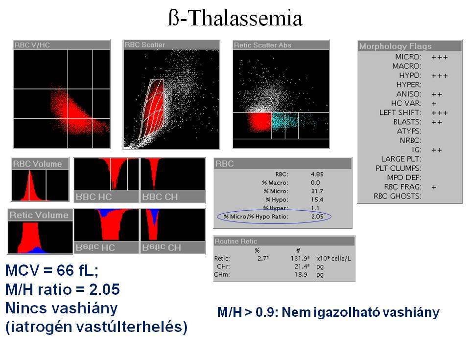 ß-Thalassemia MCV = 66 fl;