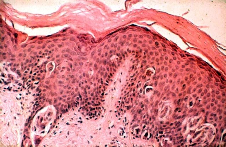 I. növekedési fázis korai fázis, horizontalis vagy radier növekedés; az epidermis és junctionalis régiók