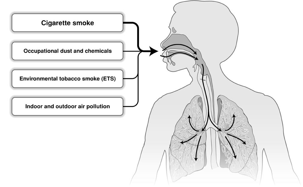 A COPD kockázati tényezői Genetikai tényezők