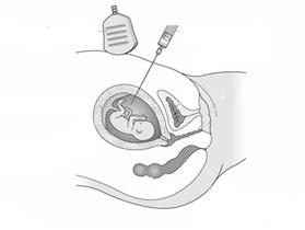 Prenatális diagnosztika Amniocentézis